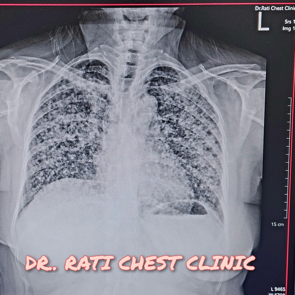 pulmonary silicosis